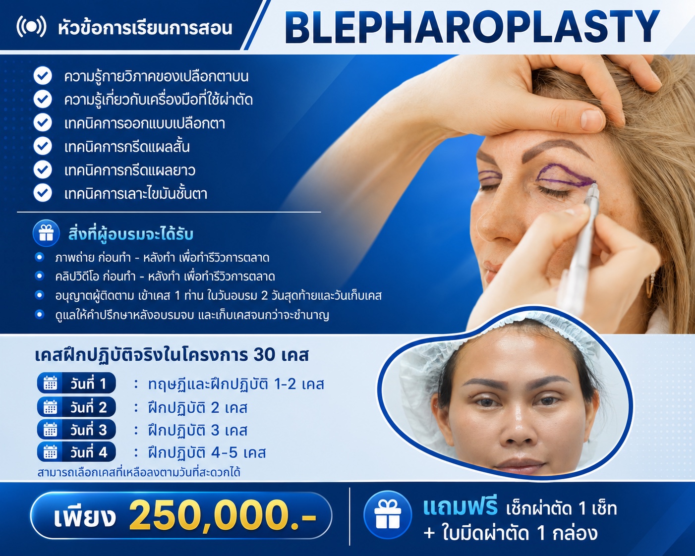 Upper Blepharoplasty