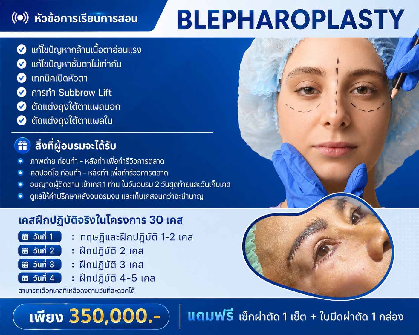 Blepharoplasty